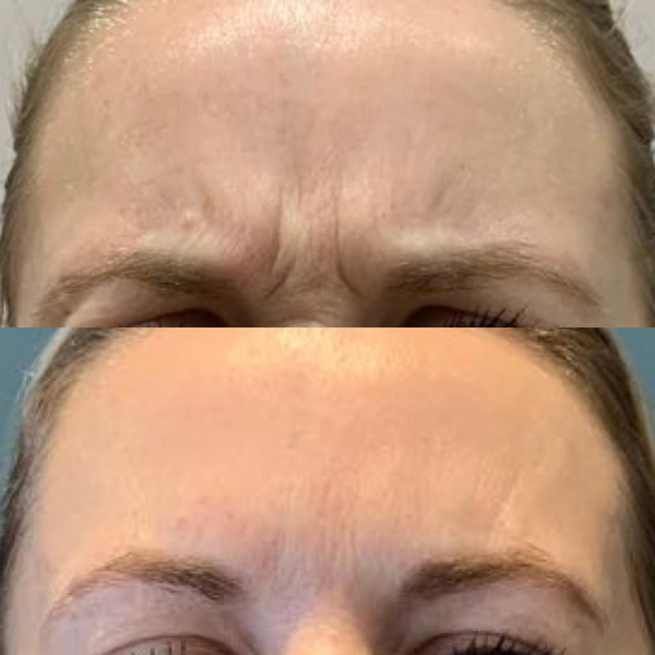 Botox is it worth it?