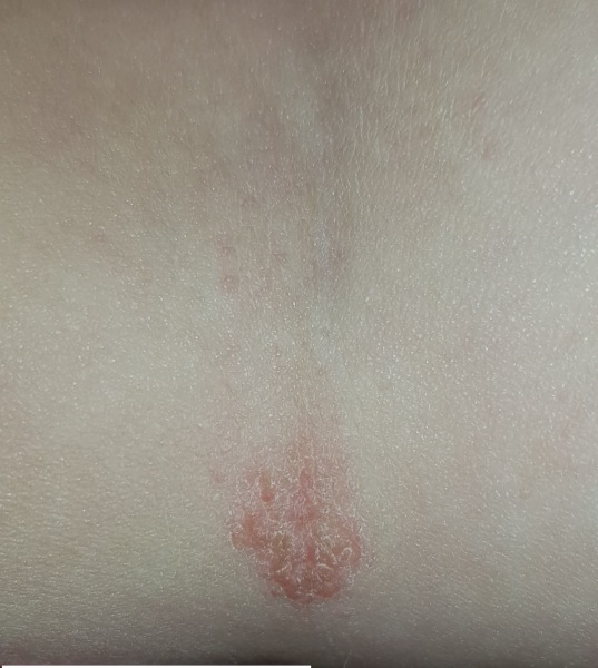 What could this rash be?