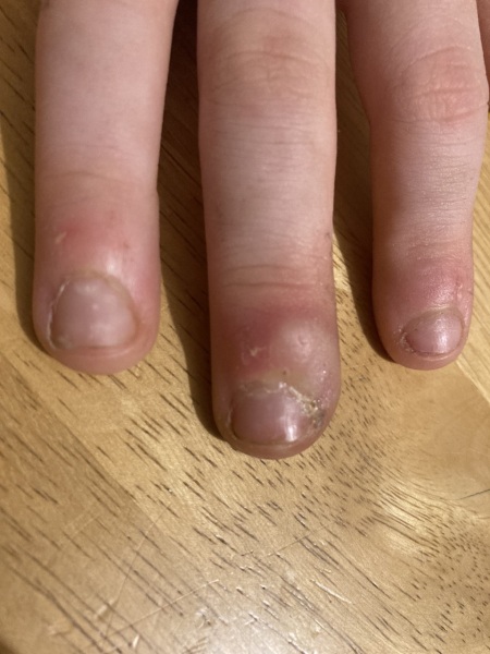 Blister on son's finger - any ideas how to treat this?
