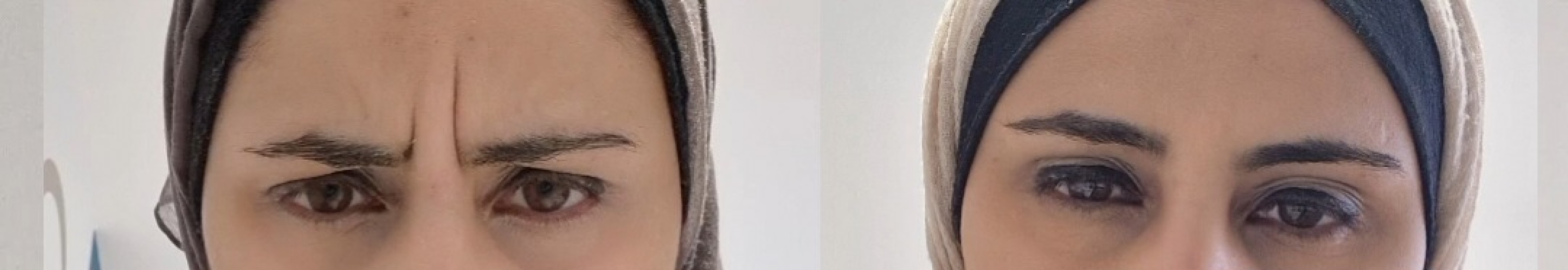 Botox is it worth it?