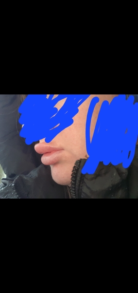 How can filler have permanently changed my lips?