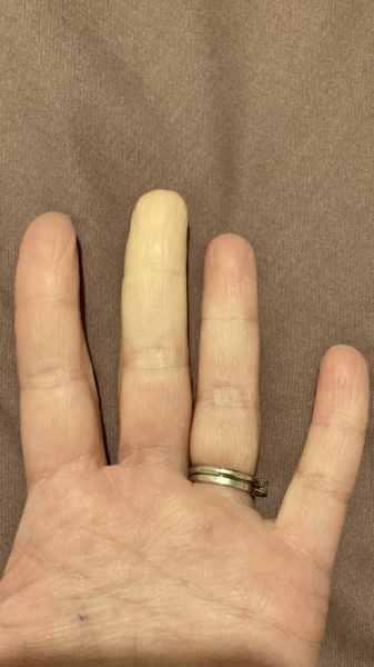 Raynauds