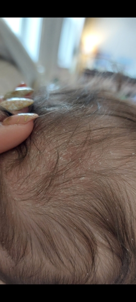 Cradle cap or eczema???