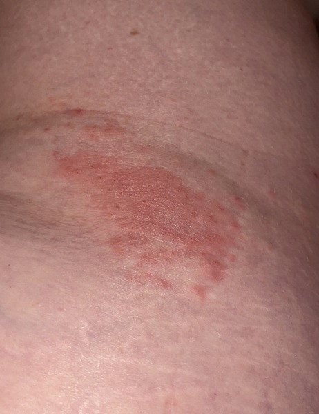 Ideas on this rash