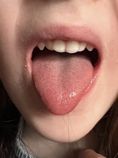 Strawberry tongue?