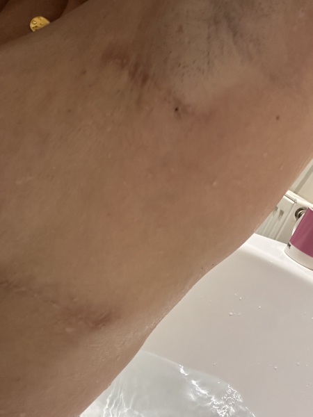 We’ve had breast reductions. Ask us anything.