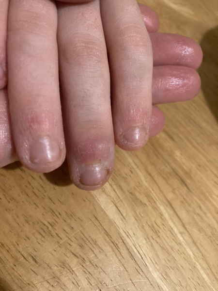 Blister on son's finger - any ideas how to treat this?