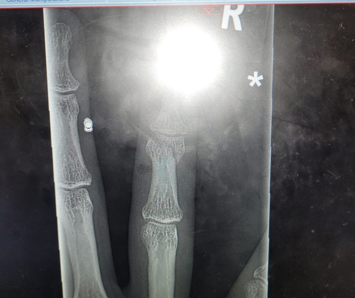 Anyone know things about broken fingers?