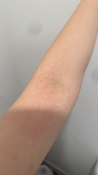 Potential Eczema?