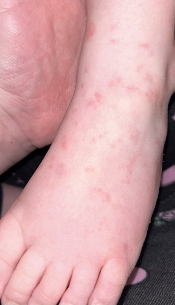 Can anyone help? No idea what this rash is