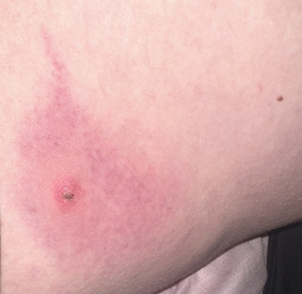 Can anyone identify this lump? (Medical, graphic photo!)