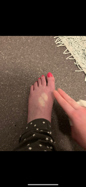 Is this Raynaulds disease? Foot Pic TW!