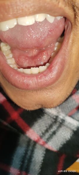 Anyone had a lump under their tongue?