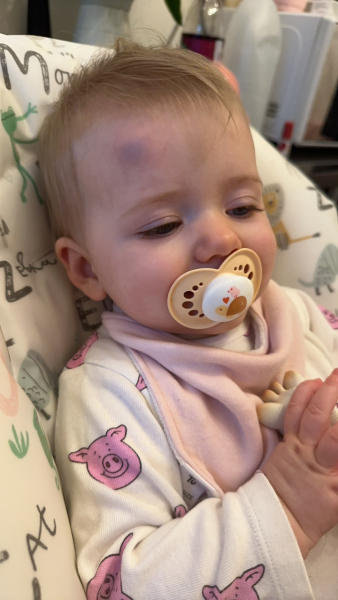 8 month old bump and bruise on head