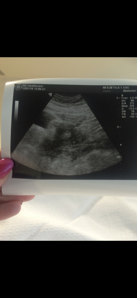 Told she was IVF