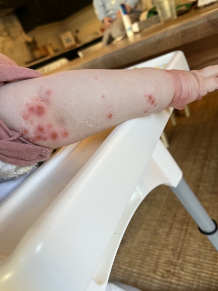 Infected eczema?
