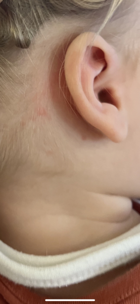 Chicken pox?