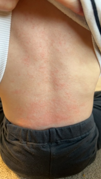 Identify this rash?