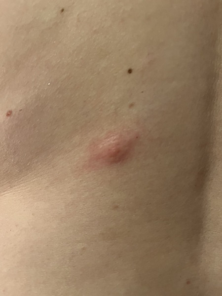 Sporners please help. What is this on my back and how do I get rid of it?!