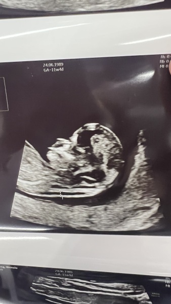 nub/skull  for 12weeks scan guess boy or girl