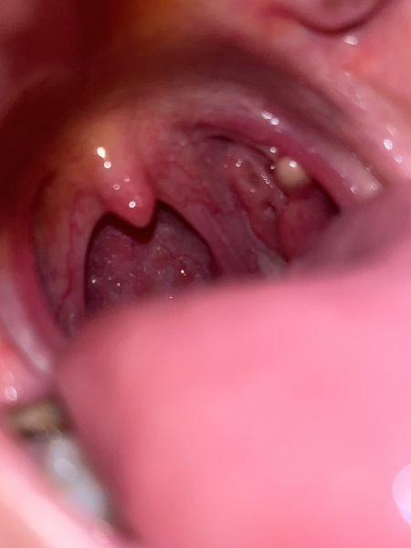 Can anyone tell me if this is a tonsil cyst?