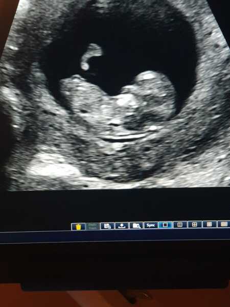 Boy or girl - anyone feel like guessing? 12wk scan