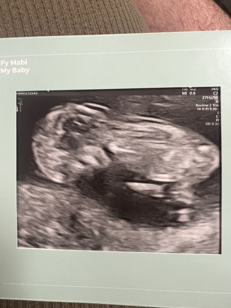 Boy or Girl - Nub/skull theory guesses?