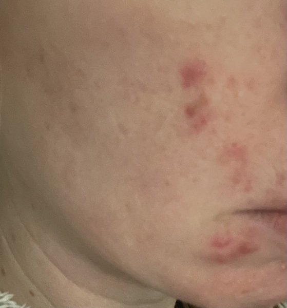 Please help, spots on face. Pic included
