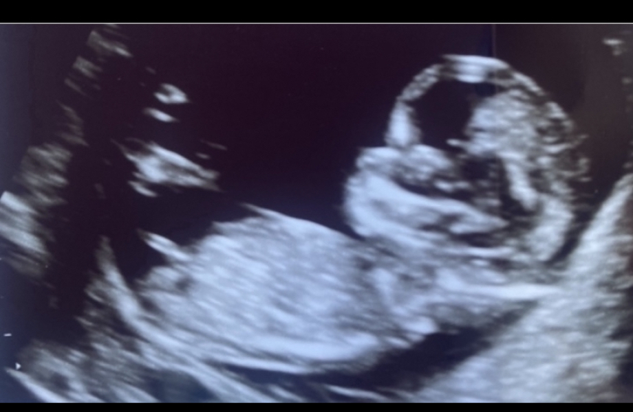 Nub theory predictions - boy or girl?