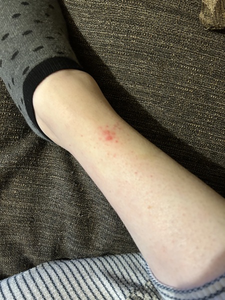 Any rash experts around?