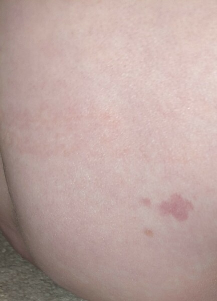 What type of birth mark is this?