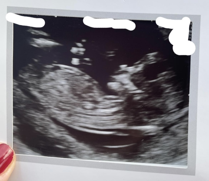 Is there a nub in this scan pic?