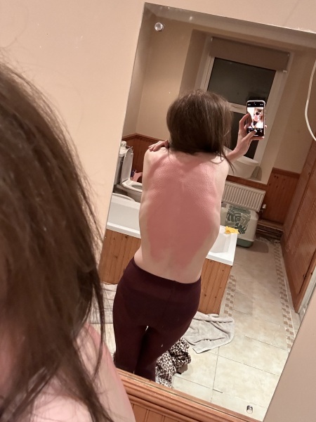Do I have scoliosis?!!