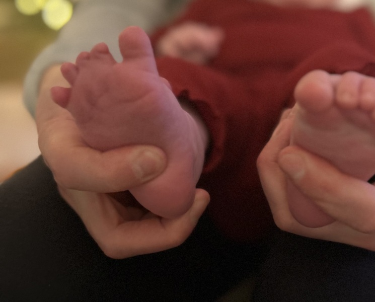 Baby Toe Deformity