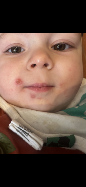 Chicken pox?