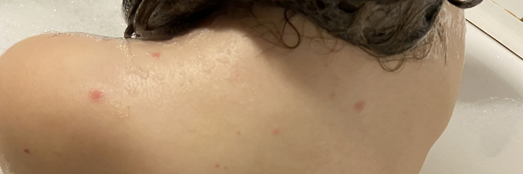 Is this chicken pox?