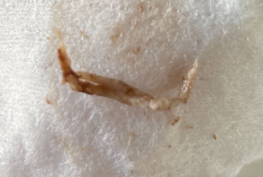 Bits of string in discharge