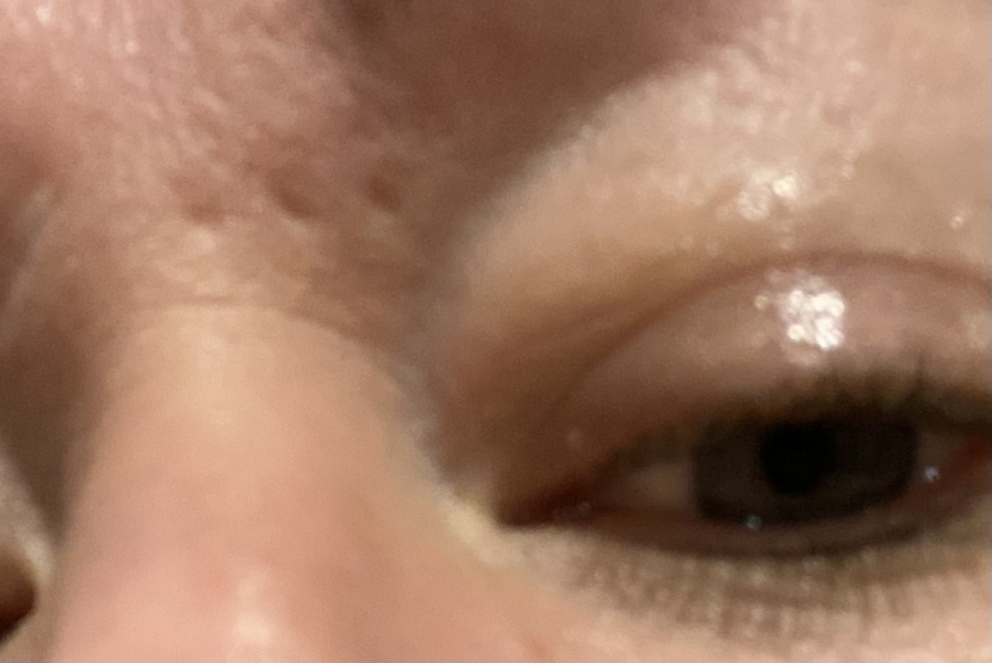 Following on from my accident post - now scars!