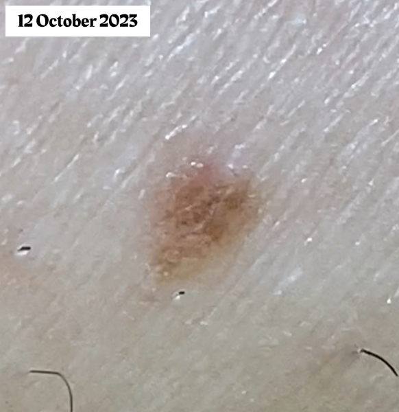 They postponed my appointment with the dermatologist 3 times. I don’t know what to do with this mole!