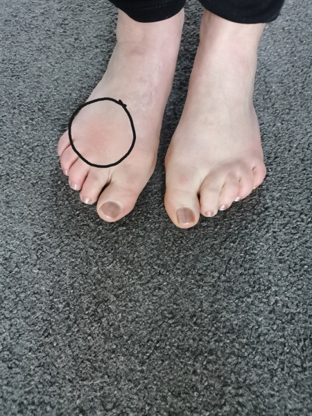 Sore foot