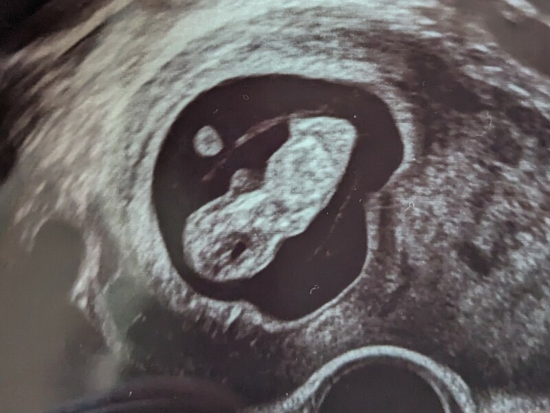 Is 10.5 week too early for nub theory?!