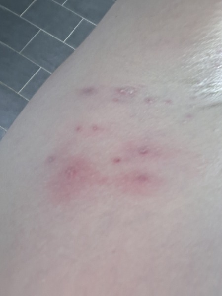Is this shingles.