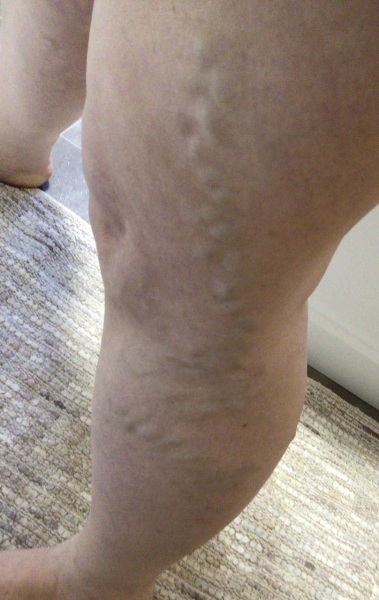 Has anything helped your varicose veins? Photo too