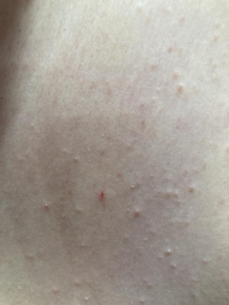 Spots on chest