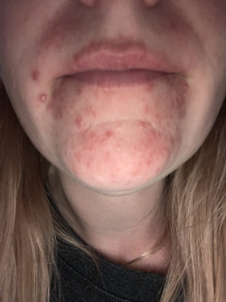Please help my spotty chin (with pics)