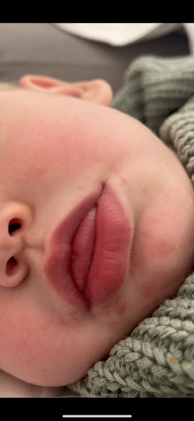 Toddler face rash and sore tongue