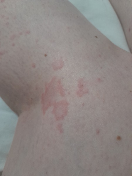 Rash/hives