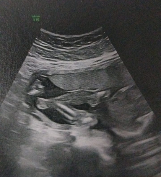 Boy or Girl