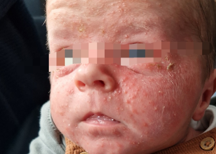 Baby face rash
