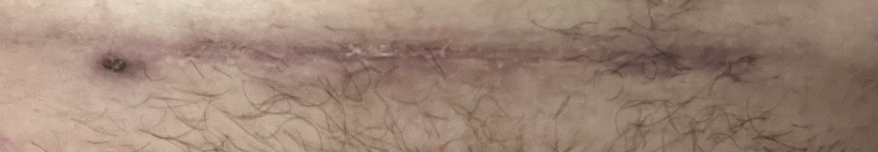 Does my section incision look like it's healing okay? (Pic)